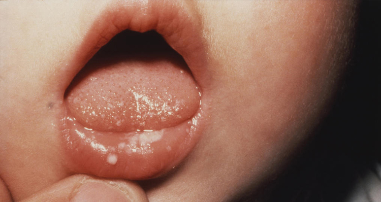 Làm thế nào mà trẻ sơ sinh nấm lưỡi