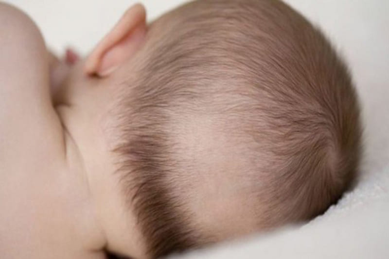Rụng tóc vành khăn ở trẻ sơ sinh và cách chữa trị.