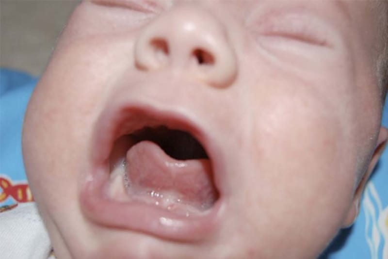 6 Dấu hiệu trẻ sơ sinh có thể bị dính thắng lưỡi